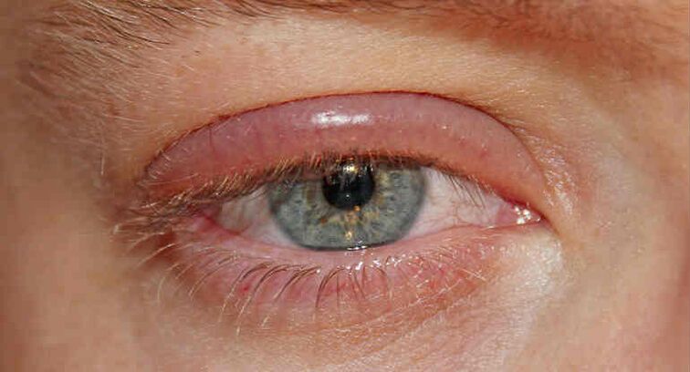 Demodectic mange on eyelids