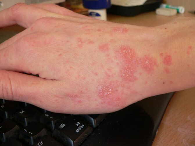 Human hand affected by scabies